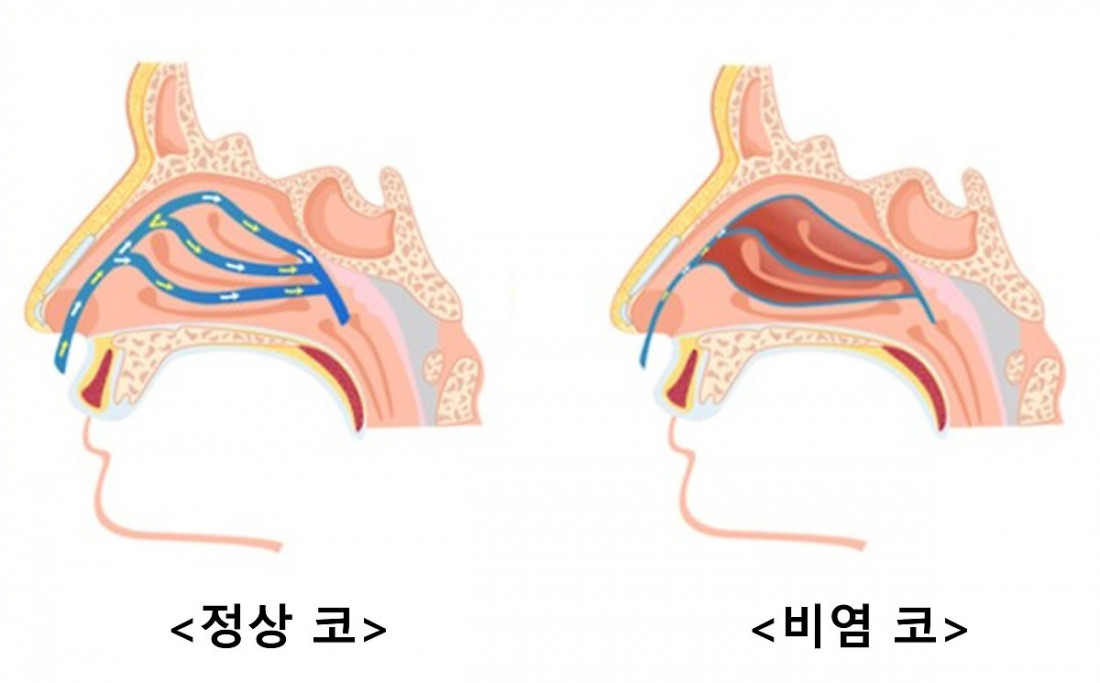 8년간 우리 아들 괴롭힌 비염,축농증 극복한 후기 (2024.07.17) Photo-Image