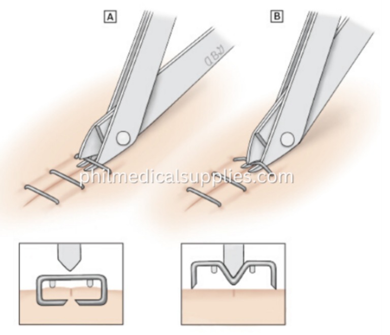의료용 스테이플러 (Skin Stapler) 제거 방법 (자가 제거 비추) Photo-Image